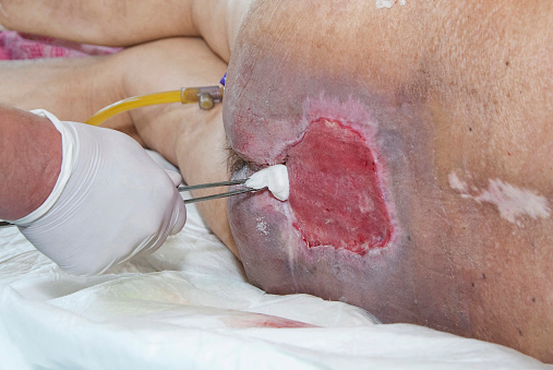 Bedsores (Pressure Ulcers) Condition, Treatments and Pictures for