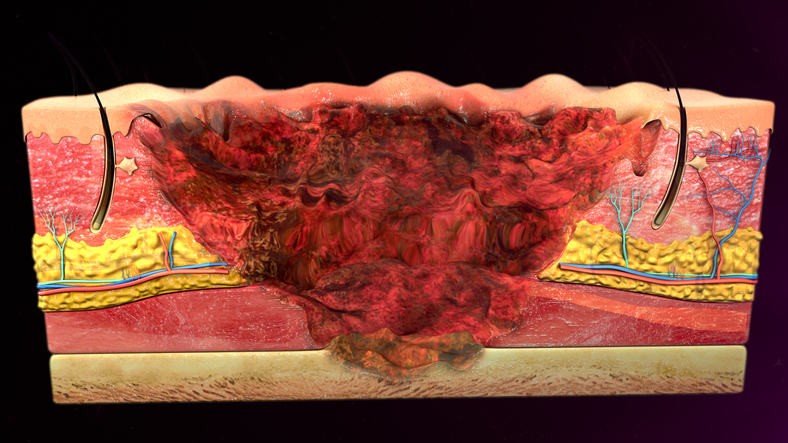 Skin Burn Diagram